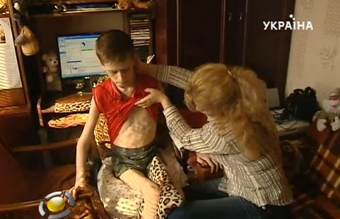 Хто врятує двадцятитрьохрічного Олега з Вінниці, хворого на нейрофіброматоз?