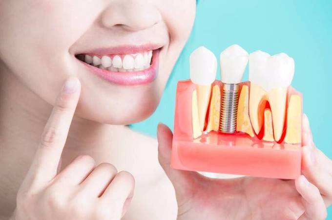 Що можна їсти після встановлення зубних імплантів?
