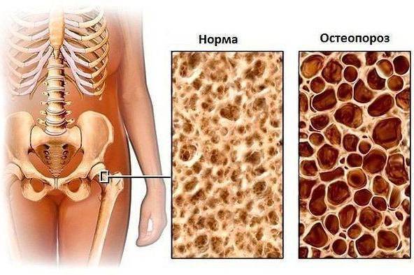 Остеопороз: причини й профілактика
