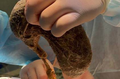 Синдром “Рапунцель”: зі шлунку 11-річної вінничанки дістали величезний жмут її власного волосся