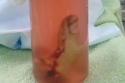 Вінницькі лікарі пришили чоловікові палець, який він привіз у банці. ФОТО