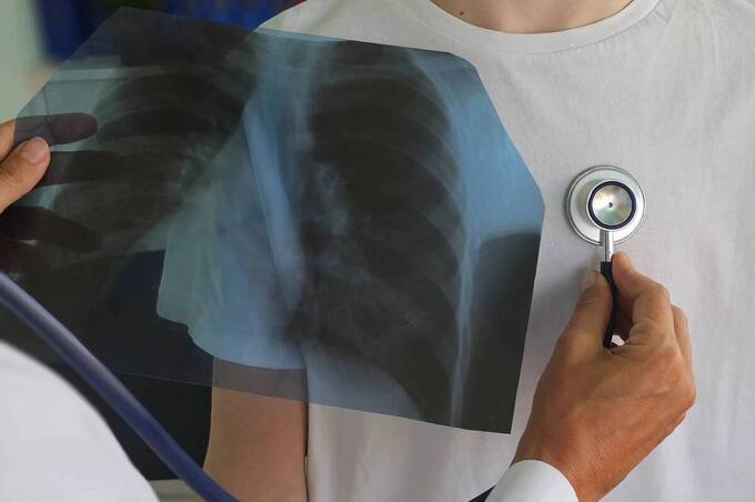 На Вінниччині за січень 2026 року зафіксували 48 випадків туберкульозу