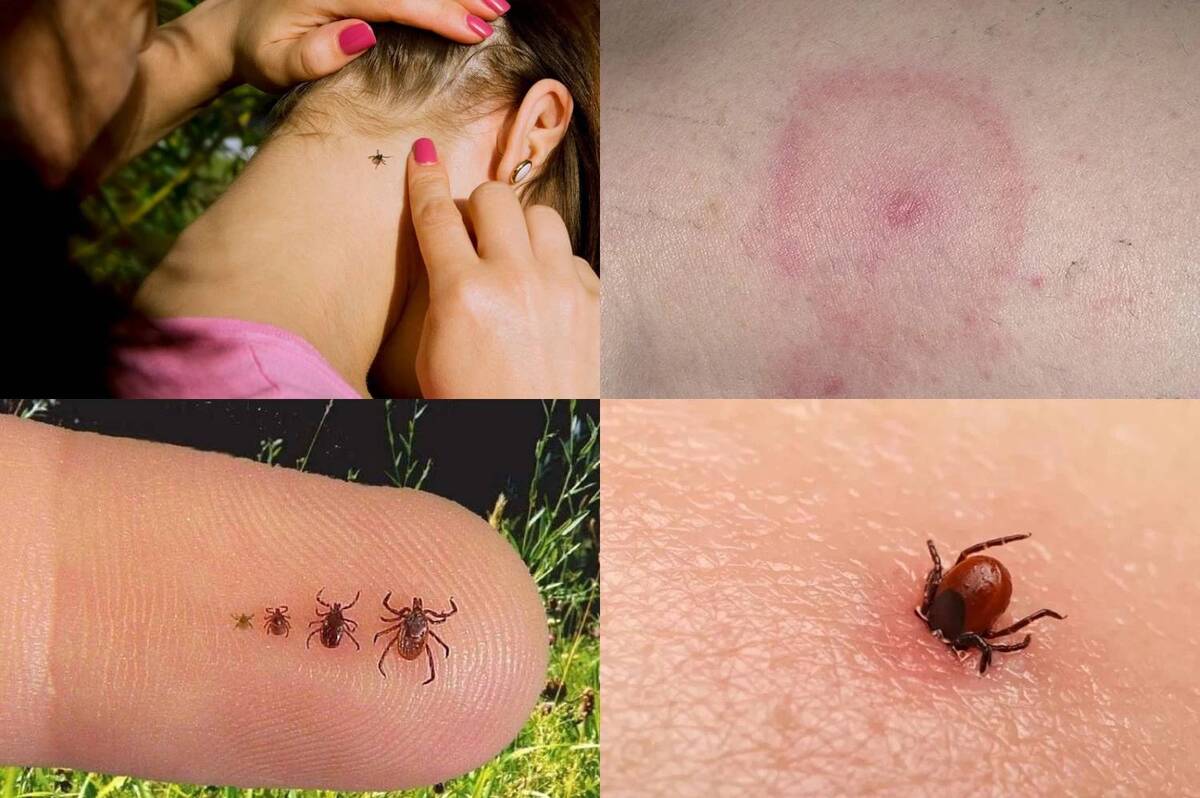Кількість випадків хвороби Лайма у Вінницькій області пішла на спад у лютому